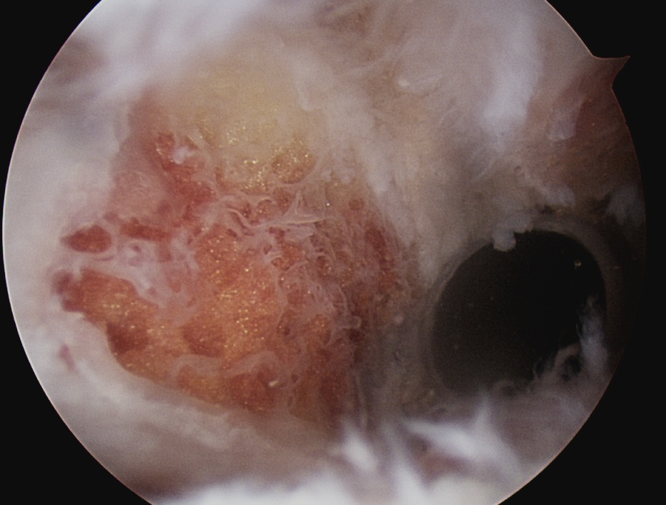 ACJ OA Debridement 2